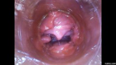 RAW endoscopic video [February 8, 2016] - screenshot from the video #4