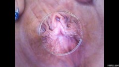 RAW endoscopic video [13 lutego 2016] - screenshot from the video #4