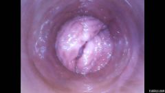 RAW endoscopic video [4 mars 2016] - screenshot from the video #7