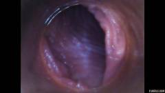RAW endoscopic video [23 agosto 2015] - screenshot from the video #6