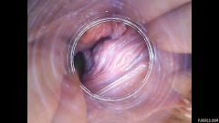 RAW endoscopic video [23 de abril de 2016] - screenshot from the video #1