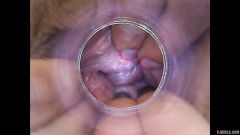 RAW endoscopic video [23 de abril de 2016] - screenshot from the video #3