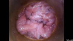 RAW endoscopic video [23 de agosto de 2015] - screenshot from the video #3