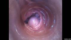 RAW endoscopic video [11. října 2015] - screenshot from the video #3