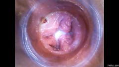 RAW endoscopic video [23. března 2016] - screenshot from the video #4