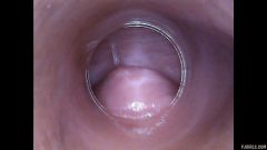 RAW endoscopic video [23 de abril de 2016] - screenshot from the video #4