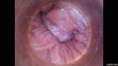 RAW endoscopic video [23 de agosto de 2015] - screenshot from the video #4