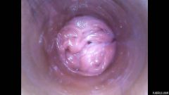 RAW endoscopic video [4. března 2016] - screenshot from the video #5