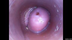 RAW endoscopic video [23. března 2016] - screenshot from the video #5