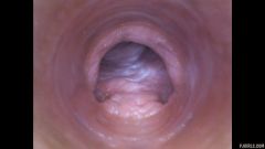 RAW endoscopic video [23 de abril de 2016] - screenshot from the video #5