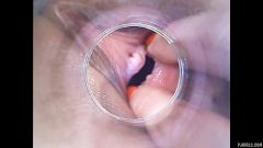 RAW endoscopic video [29. května 2016] - screenshot from the video #5