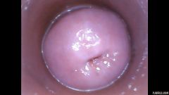 RAW endoscopic video [17. července 2016] - screenshot from the video #5