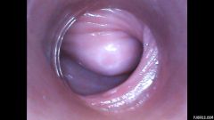 RAW endoscopic video [2016年9月18日] - screenshot from the video #5