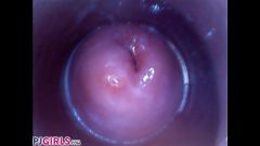 RAW endoscopic video [14 janvier 2017] - screenshot from the video #5