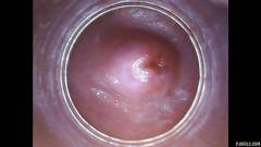 RAW endoscopic video [23 de agosto de 2015] - screenshot from the video #5