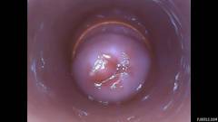 RAW endoscopic video [11. října 2015] - screenshot from the video #5