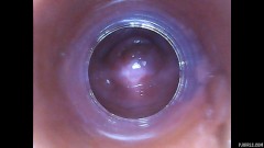 RAW endoscopic video [8. února 2016] - screenshot from the video #6