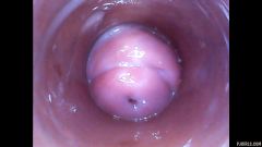 RAW endoscopic video [23. března 2016] - screenshot from the video #6
