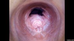 RAW endoscopic video [23 de abril de 2016] - screenshot from the video #6