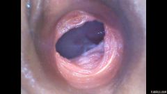 RAW endoscopic video [29. května 2016] - screenshot from the video #6