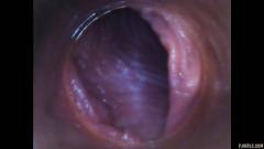 RAW endoscopic video [23 de agosto de 2015] - screenshot from the video #6