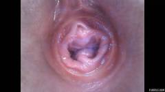 RAW endoscopic video [11. října 2015] - screenshot from the video #6