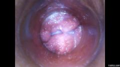 RAW endoscopic video [23. března 2016] - screenshot from the video #7
