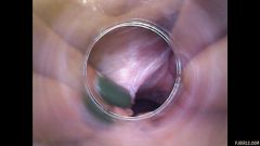 RAW endoscopic video [23 de abril de 2016] - screenshot from the video #7