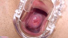 Mobile Gyno [27 de fevereiro de 2017] - screenshot from the video #7
