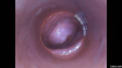 RAW endoscopic video [11. října 2015] - screenshot from the video #7
