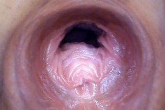 click to see the video/photos: 'RAW endoscopic video'