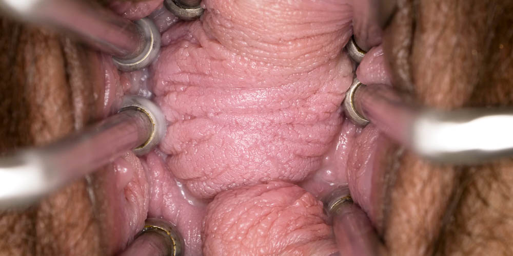 Vaginal Folds Everywhere - intro photo