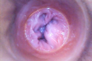 click to see the video/photos: 'RAW endoscopic video'