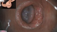 RAW endoscopic video [September 6, 2020] - screenshot from the video #4