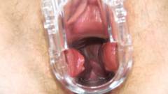 Weird cervix [March 21, 2014] - screenshot from the video #5